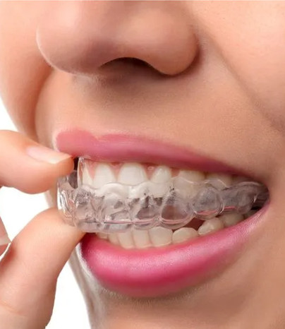 clear aligners